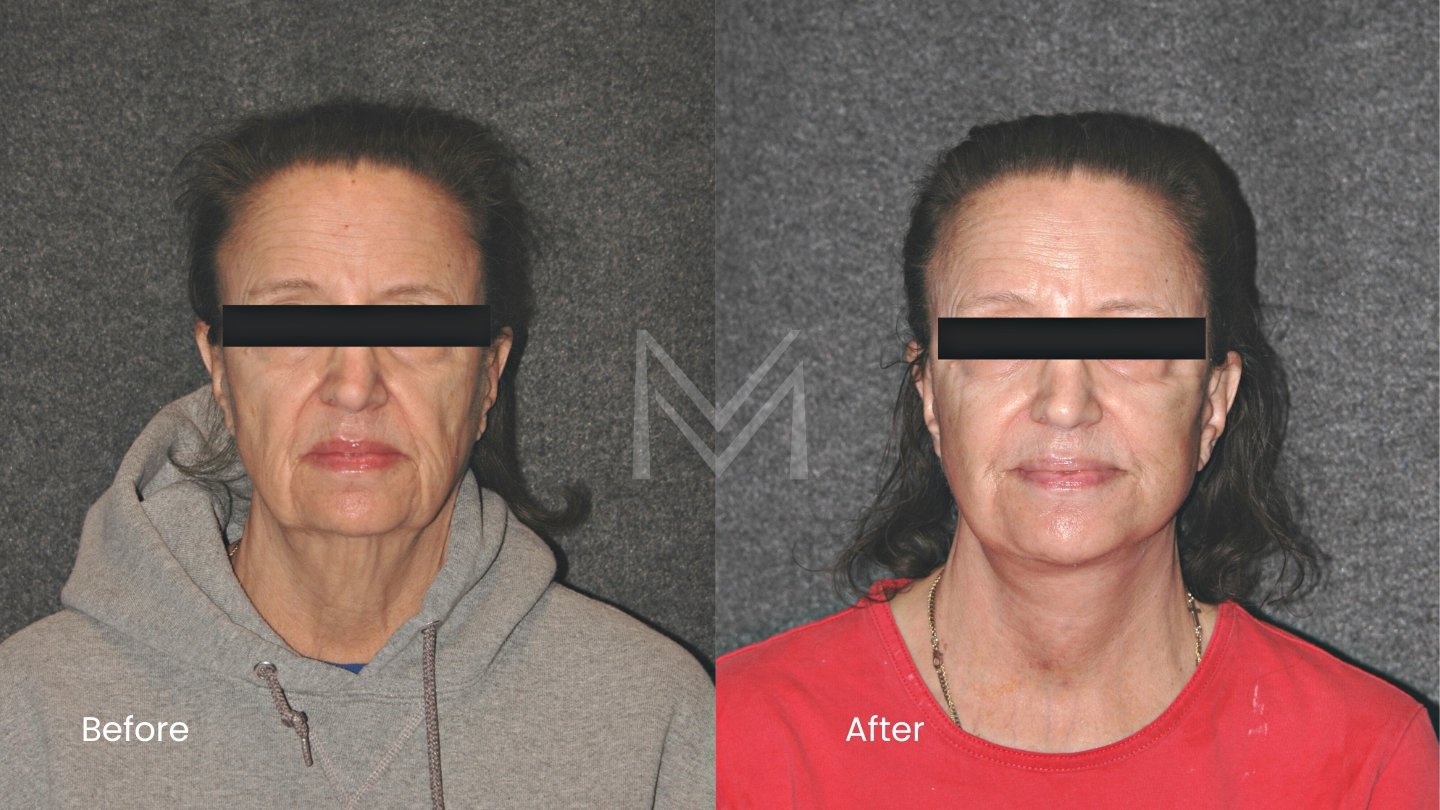 Extended Deep Plane Facelift and Neck Lift