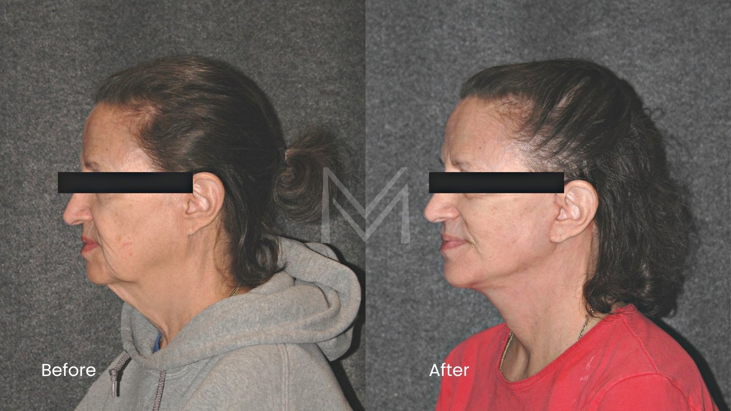 Extended Deep Plane Facelift and Neck Lift