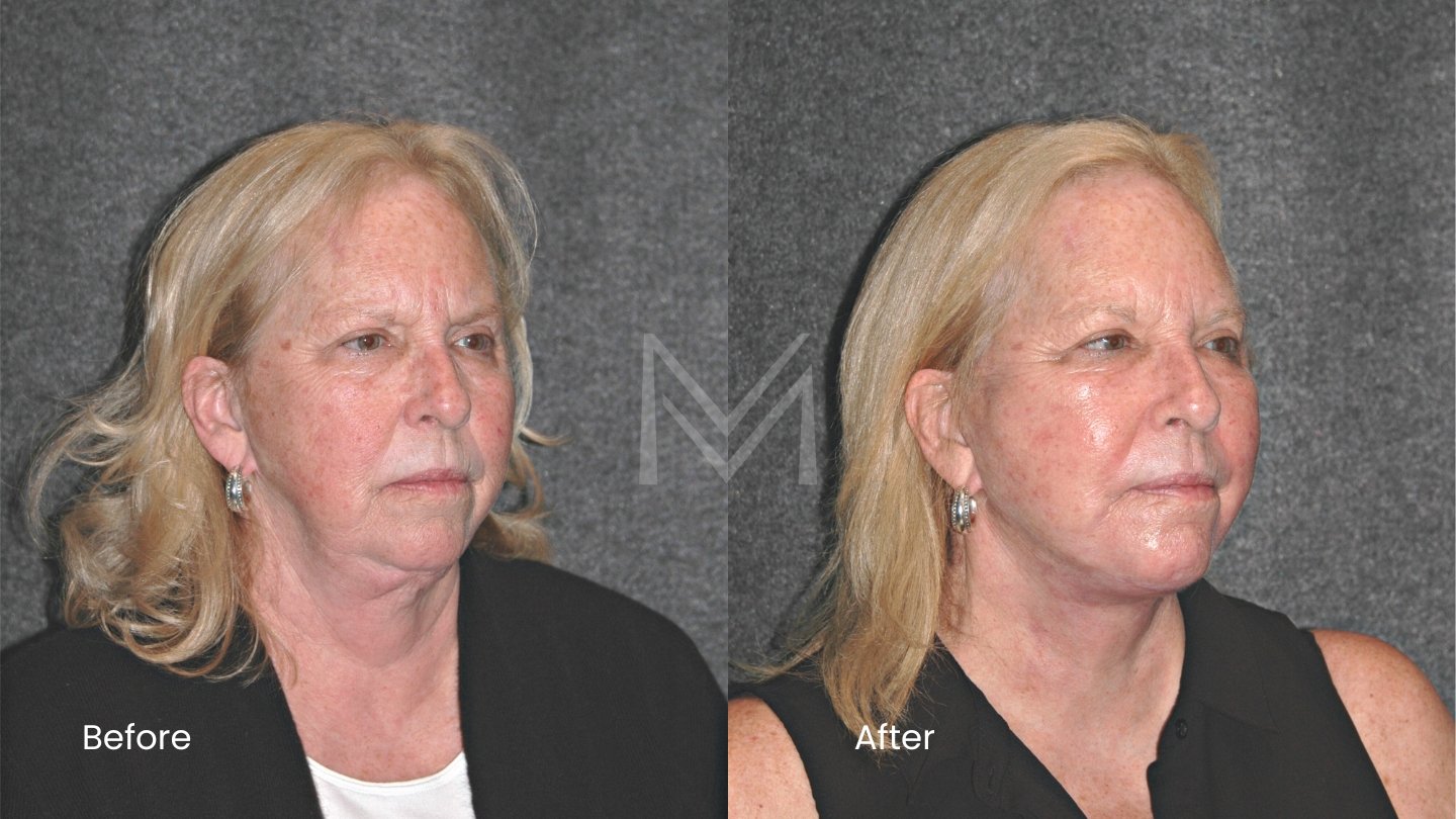 Revision Extended Deep Plane Facelift, Revision Neck Lift, CO2 Laser Resurfacing