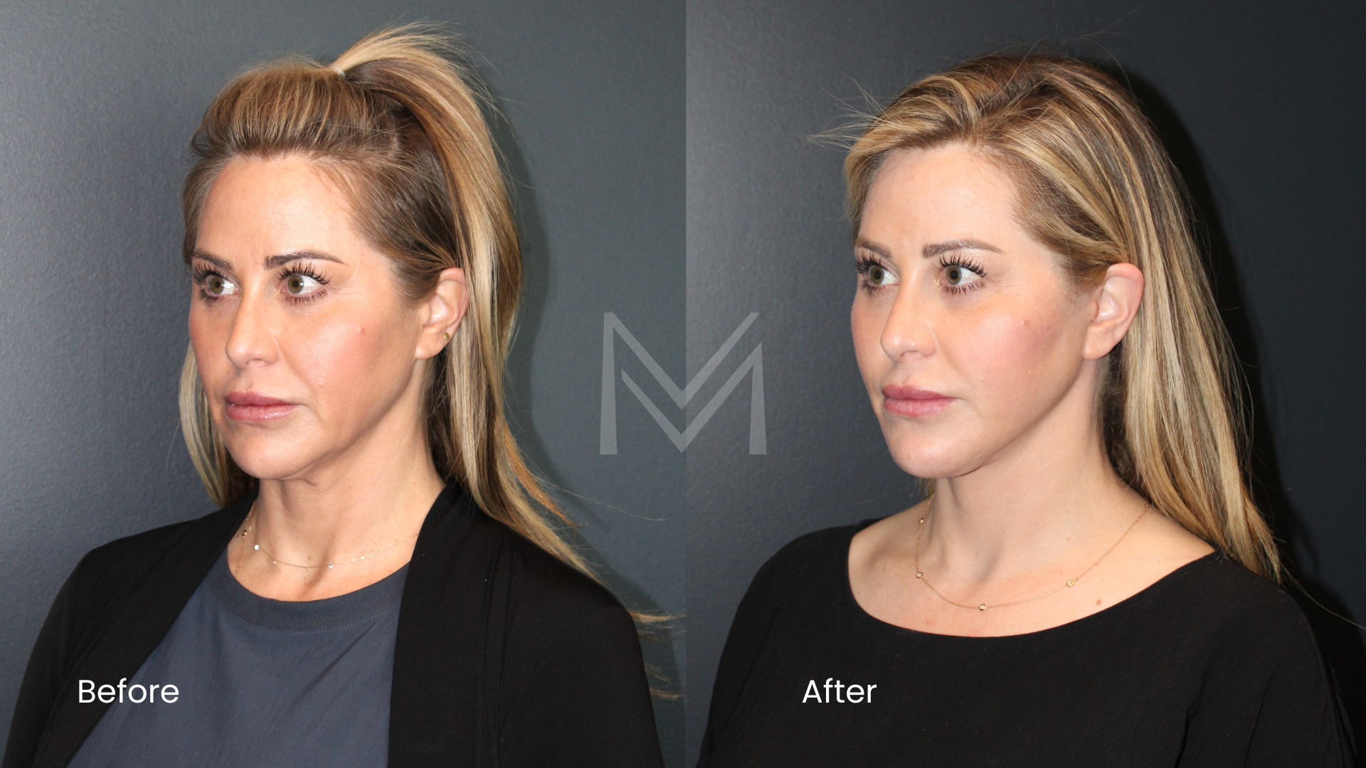 Extended Deep Plane Facelift, Neck Lift, Fat Transfer