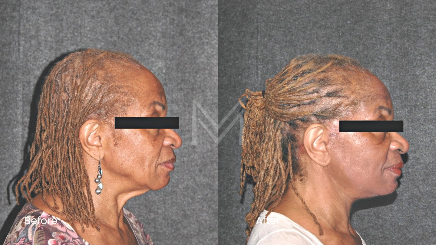 Extended Deep Plane Facelift and Neck Lift