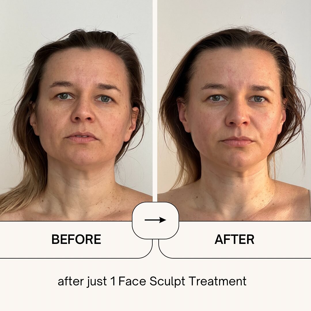 Face Sculpting Treatment /

Our beautiful client after just one treatment of sculpting massage and vacuum therapy treatment.

Book yours today.