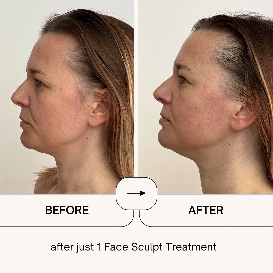 Our beautiful client after first treatment of Sculpt Face Massage.

We used manual face massage techniques and vacuum cupping therapy. Total 90mins.

Results: the upper eyelids are lifted and nasolabial folds are less visible.