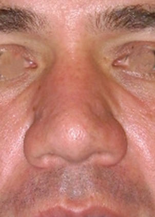 Imagen del antes de una rinoplastia estético- funcional.