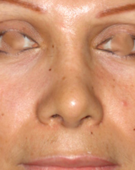 Imagen del después de una rinoplastia secundaria de punta nasal y alas con resultado con armonía de las estructuras.