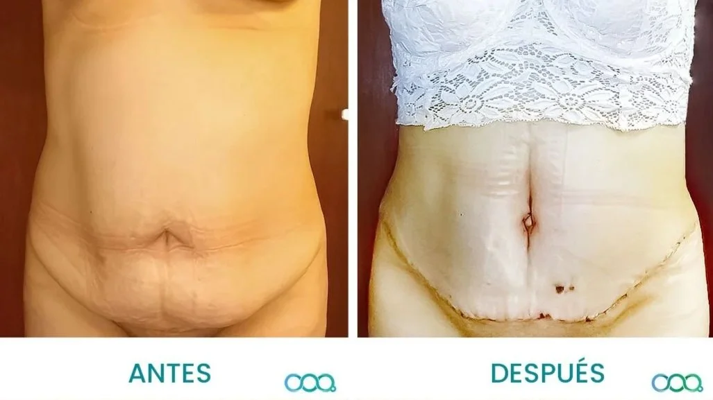 Imagen comparativa de abdomen, a la izquierda, antes de un procedimiento quirúrgico, y a la derecha, después del procedimiento, mostrando cambios en la apariencia abdominal.
