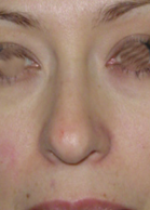 Imagen del antes de una rinoplastia solamente de la punta nasal y alas.