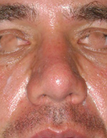 Imagen del después de una rinoplastia estético- funcional a 3 meses de la cirugía, con un resultado natural.