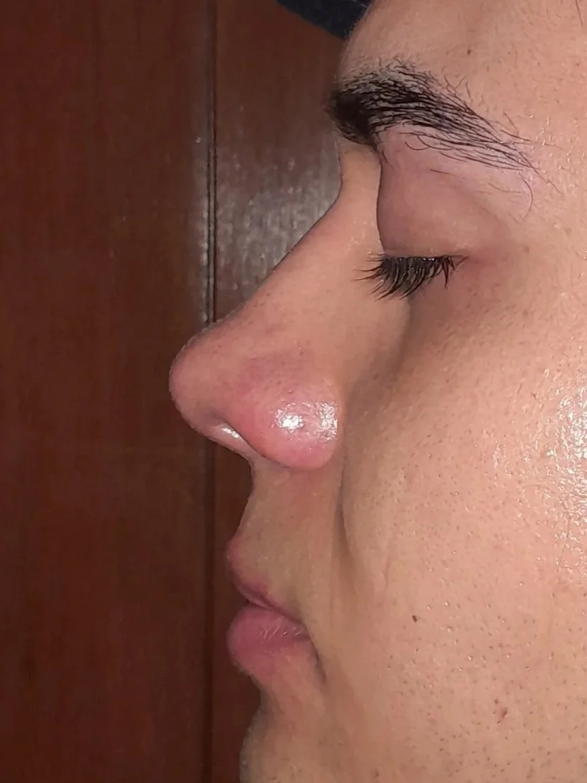 Imagen postquirurgica de rinoseptumplastia estetico-funcional en hombre.