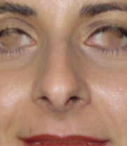 Imagen del antes de una rinoplastia estético-funcional por desviación del septum y giba dorsal importante, además de la punta nasal y alas.