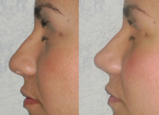 Rinoplastia estético-funcional en una paciente joven con resultado natural