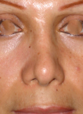Imagen del antes de una rinoplastia secundaria de punta nasal y alas.