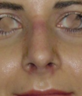 Imagen del después de una rinoplastia estético-funcional por desviación del septum y giba dorsal importante, además de la punta nasal y alas, con un resultado natural.