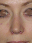 Imagen del después de una rinoplastia solamente de la punta nasal y alas.