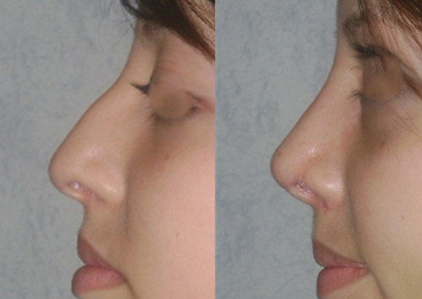 Rinoplastia estético-funcional en paciente con desviación del septum y giba dorsal, resultado natural