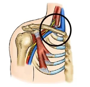 Do you carry a heavy pack often or sit at a desk? I bet your first rib needs a little help.