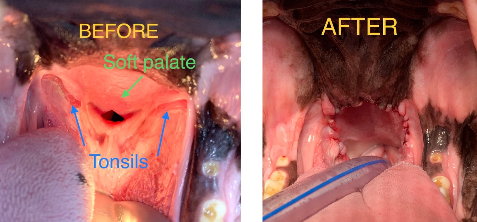 Before and After - Folded Flap Palatoplasty