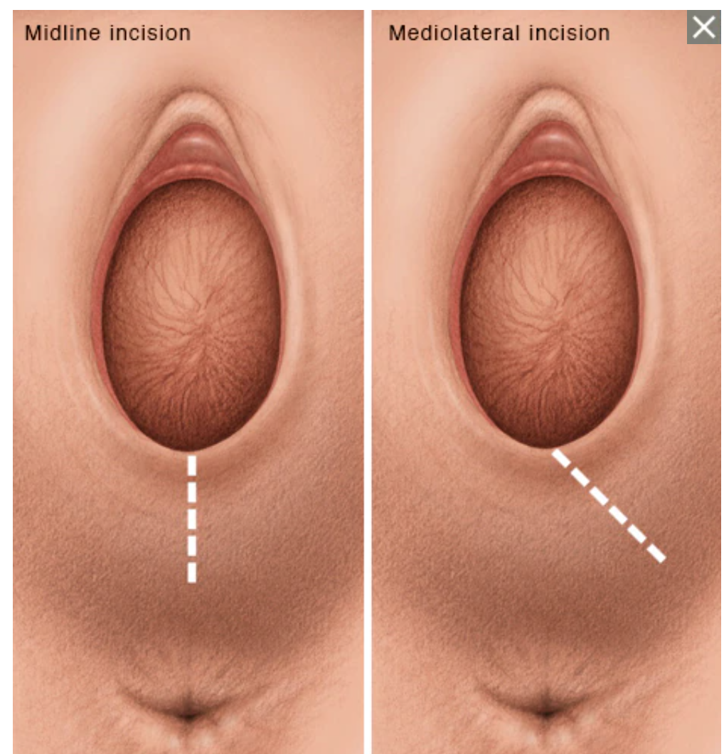 Episiotomy in Singapore: What Every Mum Should Know by Birth Doula &amp; &nbsp;Dr Rita Ren Women’s Physio Insights