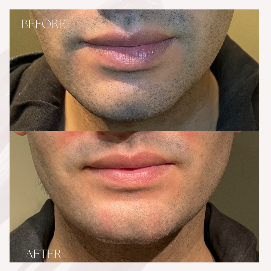 Chin & Jawline filler