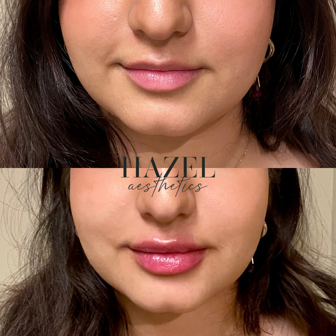 Lip Filler