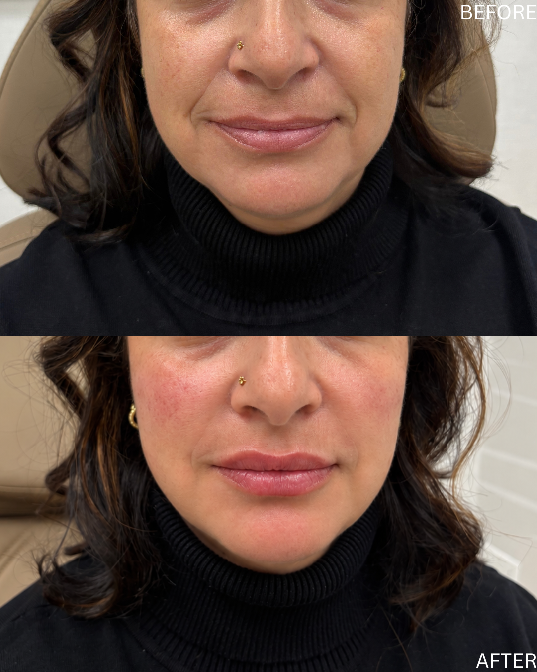 Smiles lines, Bilateral cheek and lips