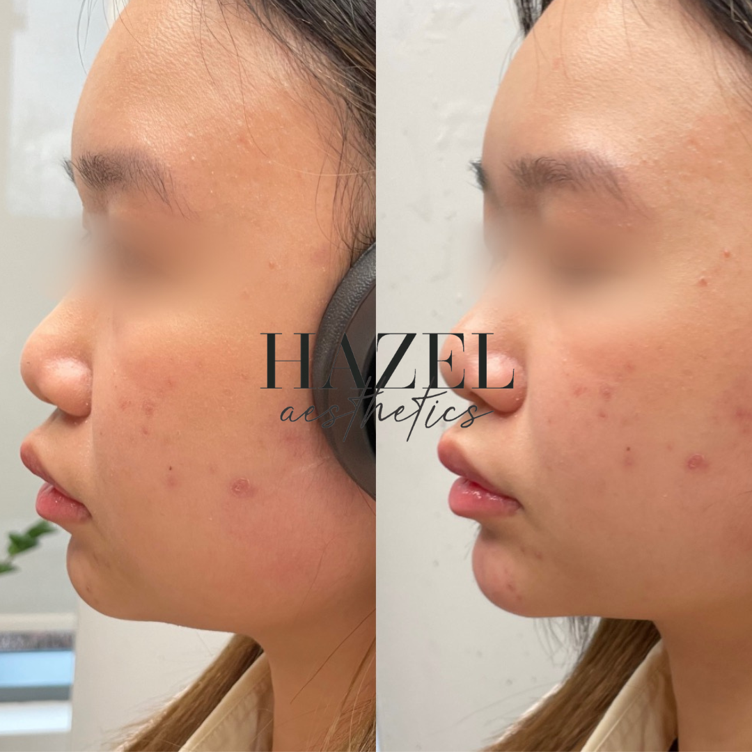 Chin Filler