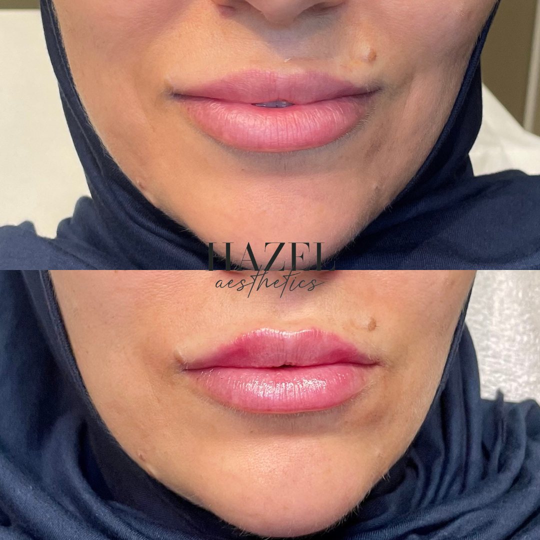 Lip filler