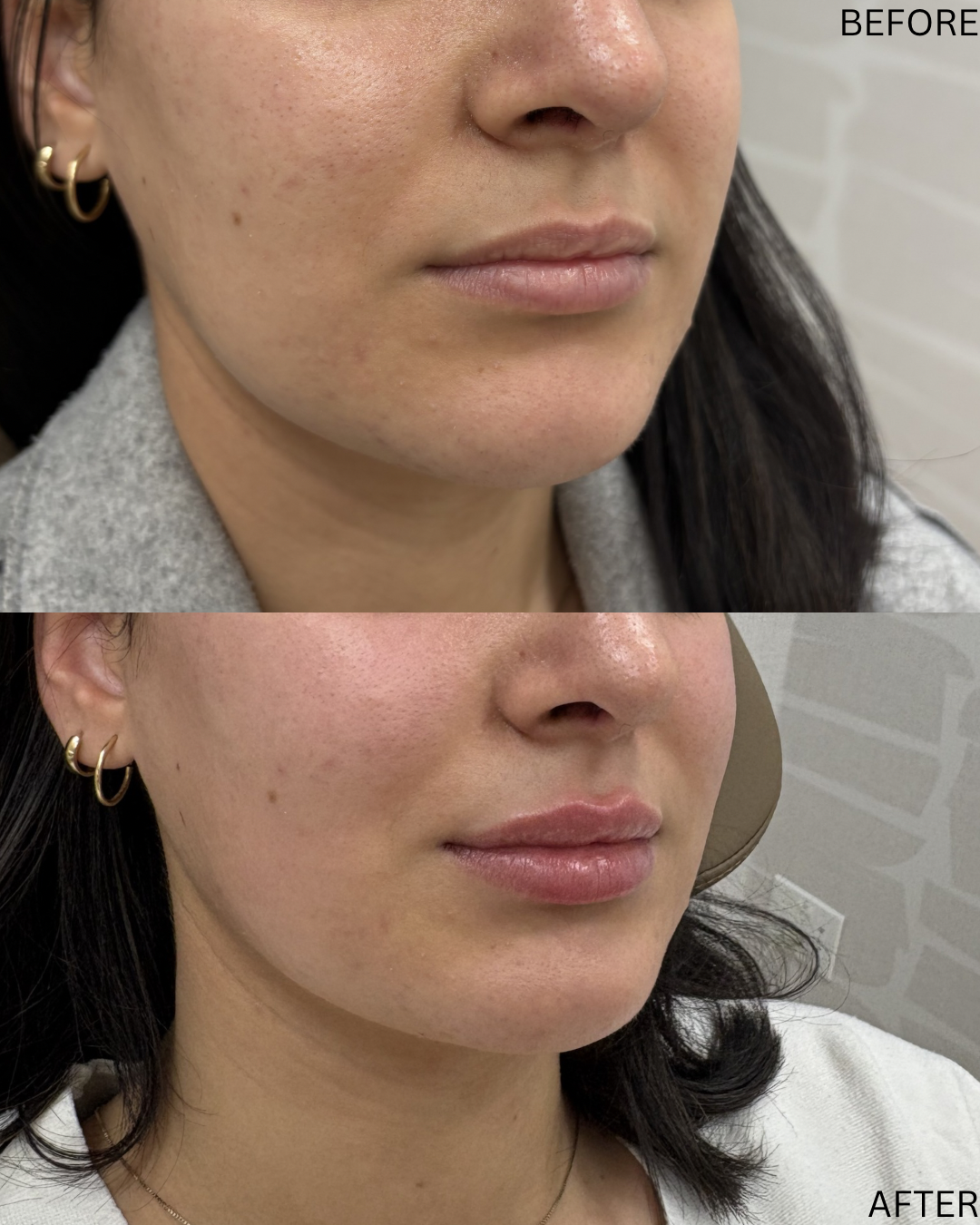 Lip filler for hydration and structure