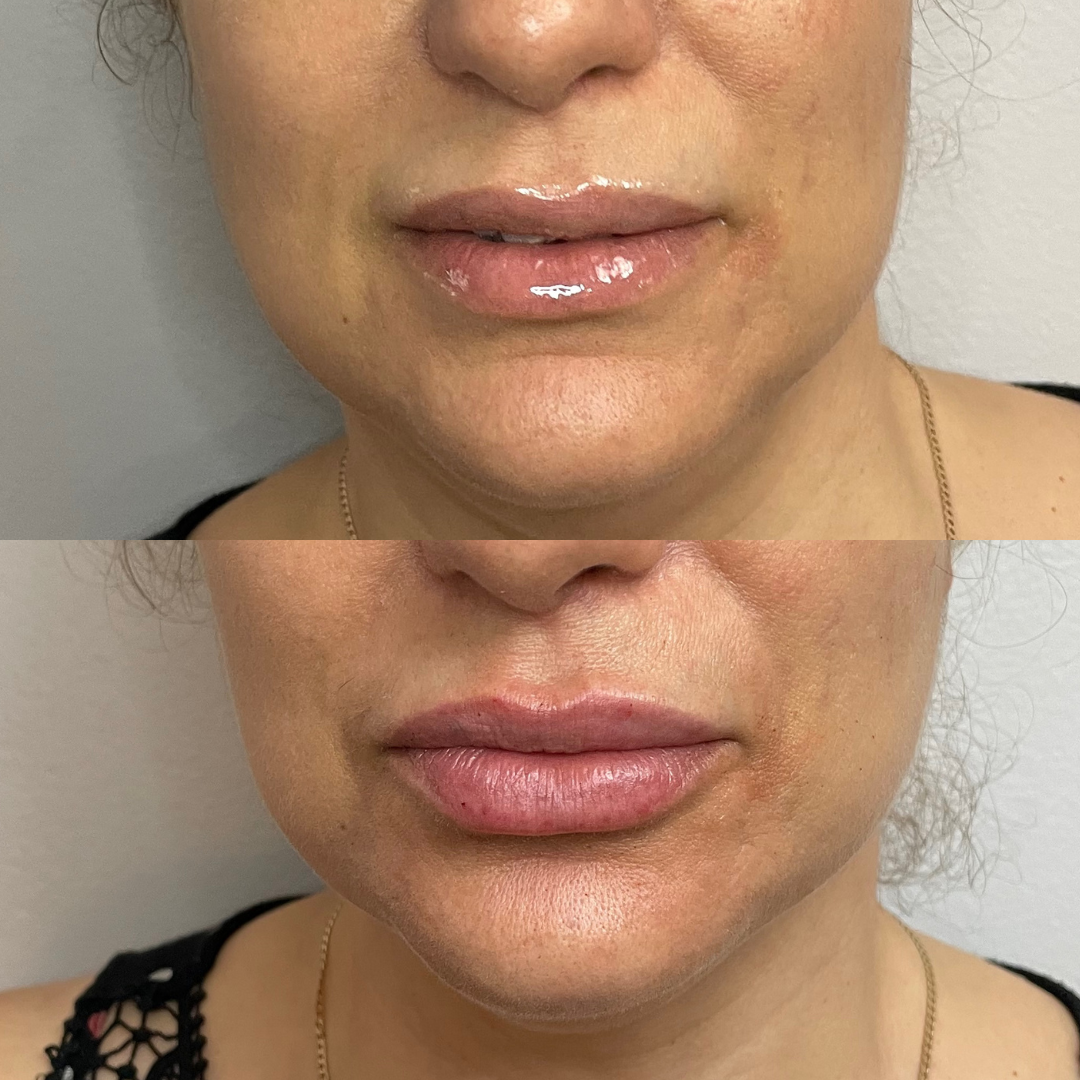 Lip Filler