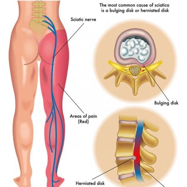 The Sciatica Lie: Why Your “Pinched Nerve” Might Not Be What You Think