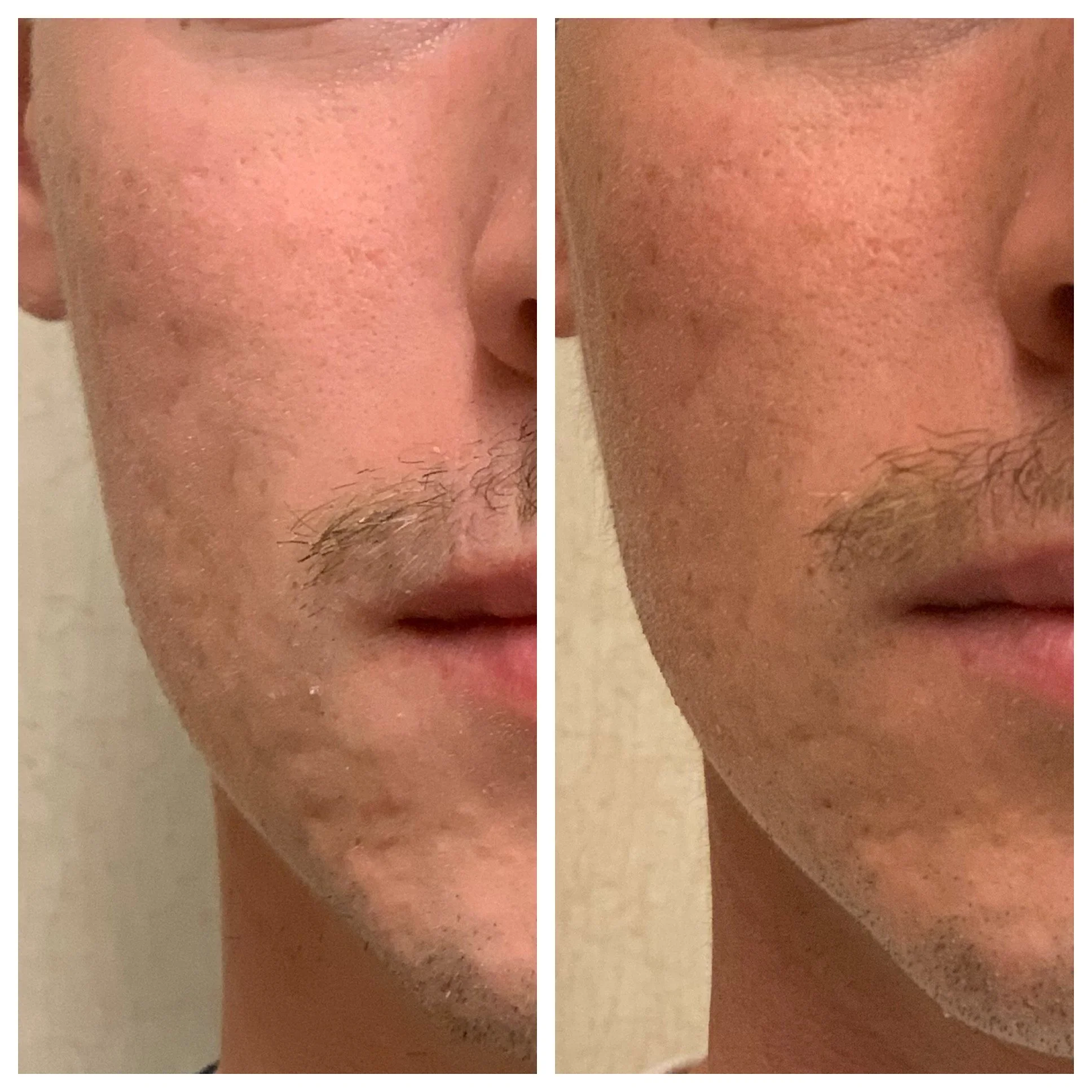 MicroNeedling w_RF(1).JPG