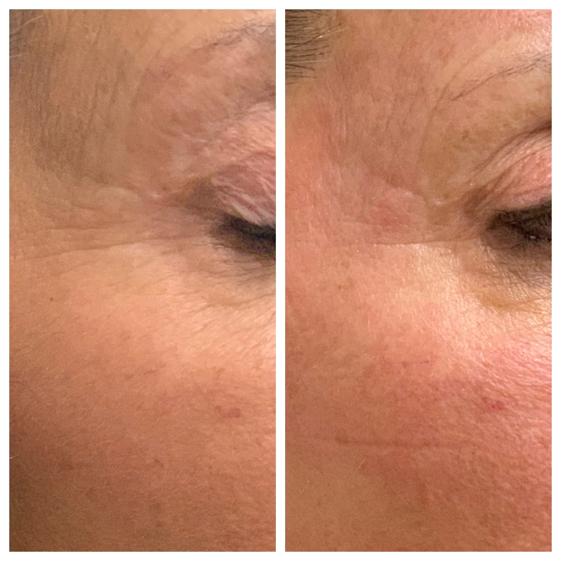 MicroNeedling w_RF(5).JPG