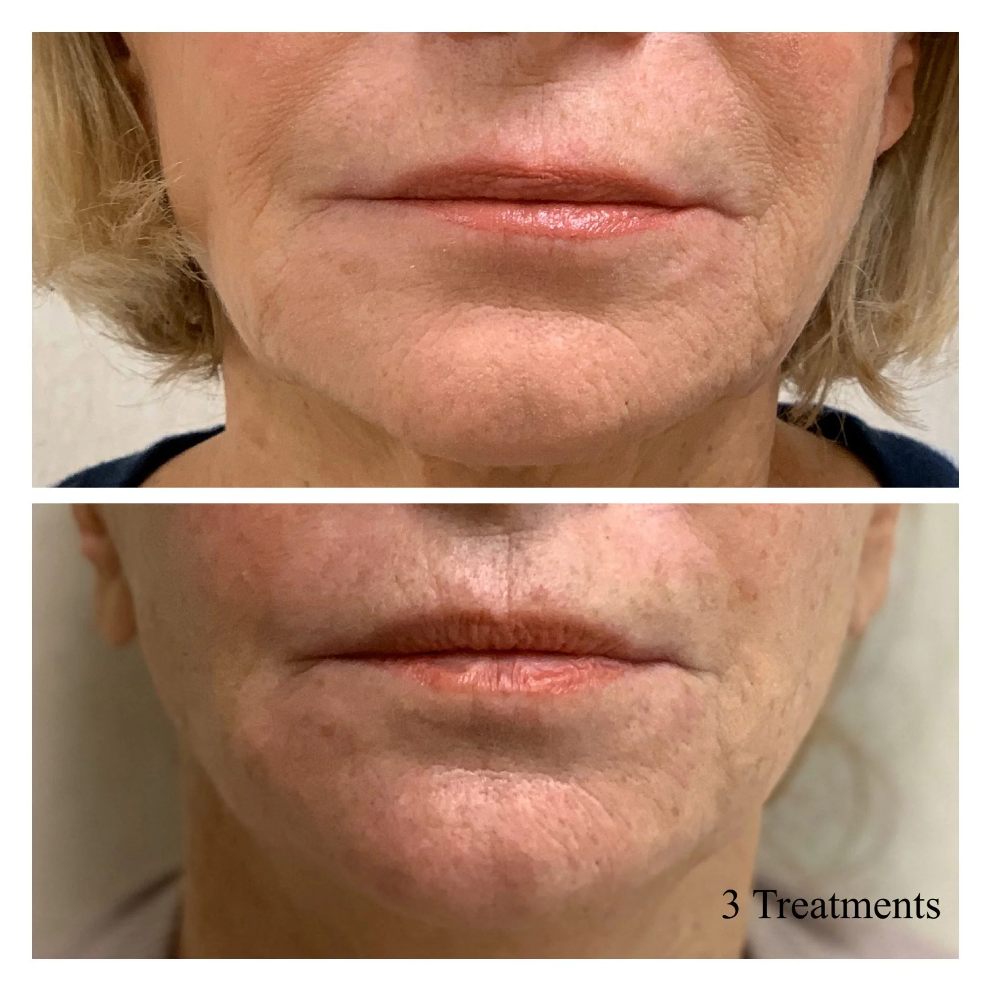 MicroNeedling w_RF.JPG