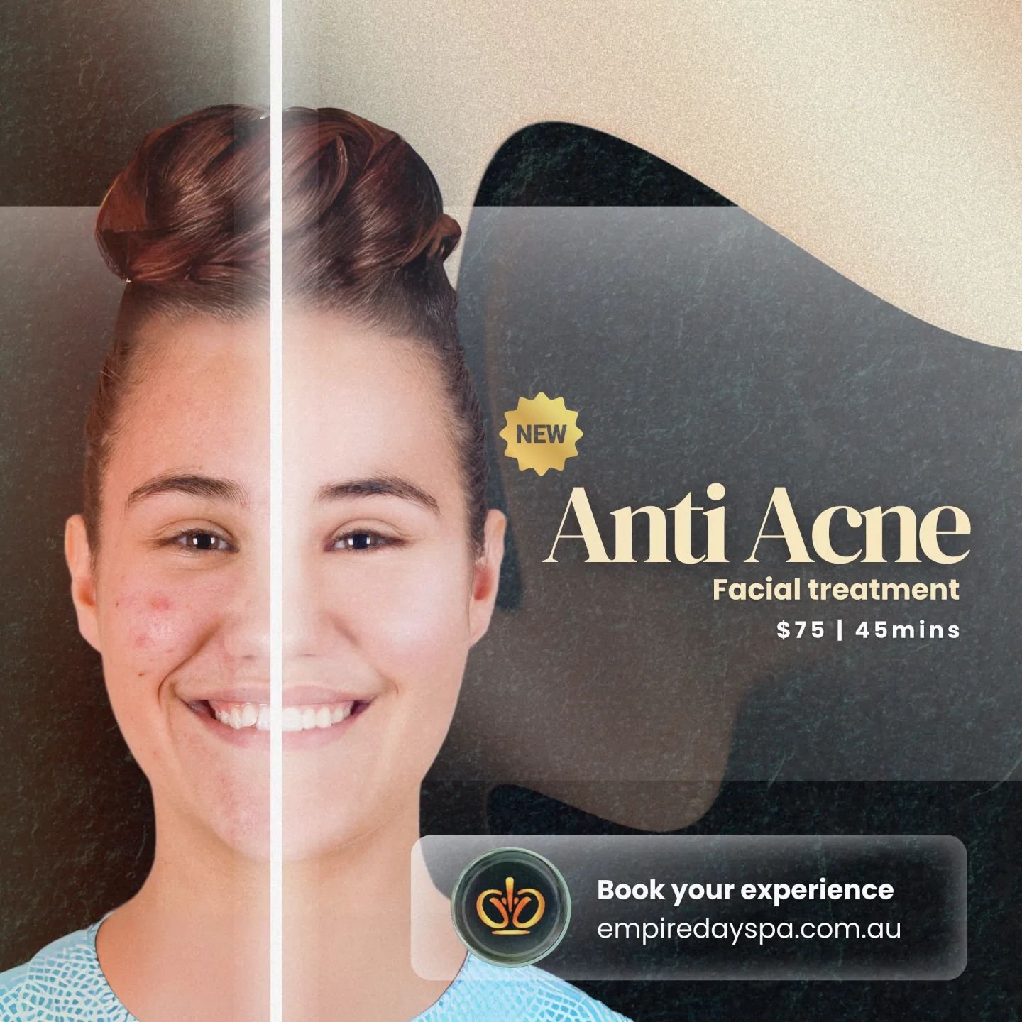Say goodbye to breakouts and hello to healthy, confident skin with Empire Day Spa's advanced anti-acne facial! 

Our powerful yet gentle treatment combines cutting-edge technology with natural ingredients to combat acne and promote lasting clarity. ✨
