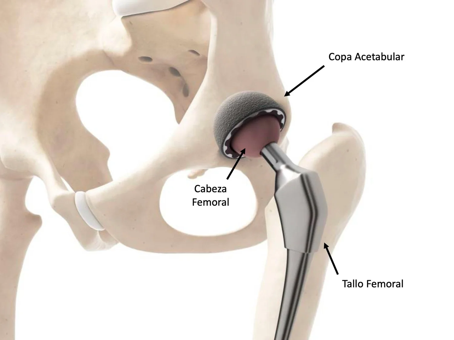 Osteoporosis Fracturas De Cadera OsteoFit Ortopedia Y Traumatologia osteoporosis-fracturas-de-cadera-osteofit-ortopedia-y-traumatologia
