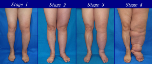 Progression of leg appearance across four stages, showing changes in muscle tone and skin condition.