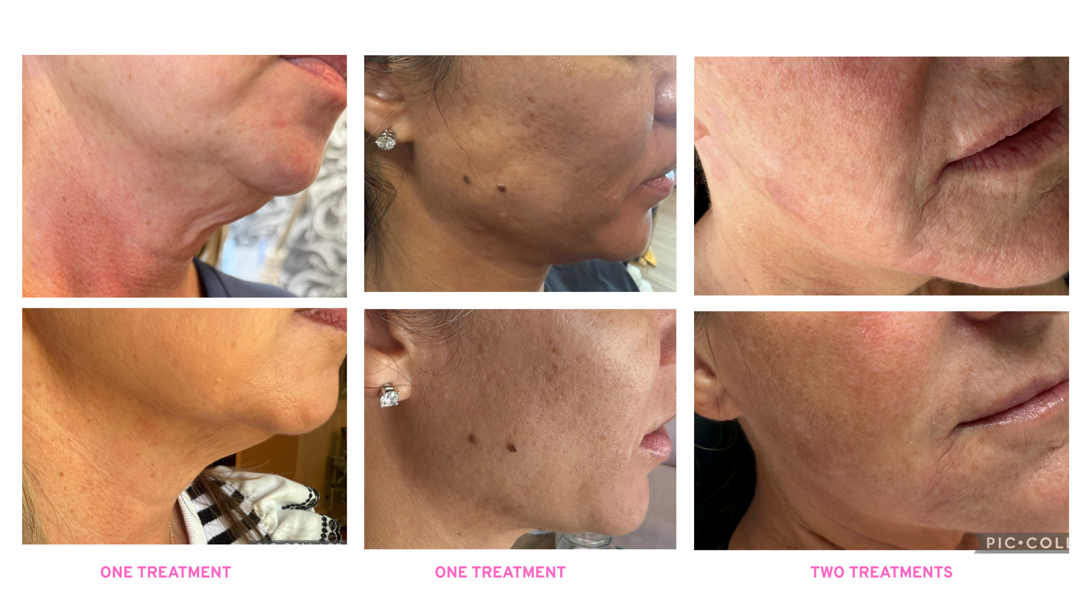 Why Genius RF Microneedling Is the Smartest Choice for Skin Rejuvenation In Charlotte, North Carolina