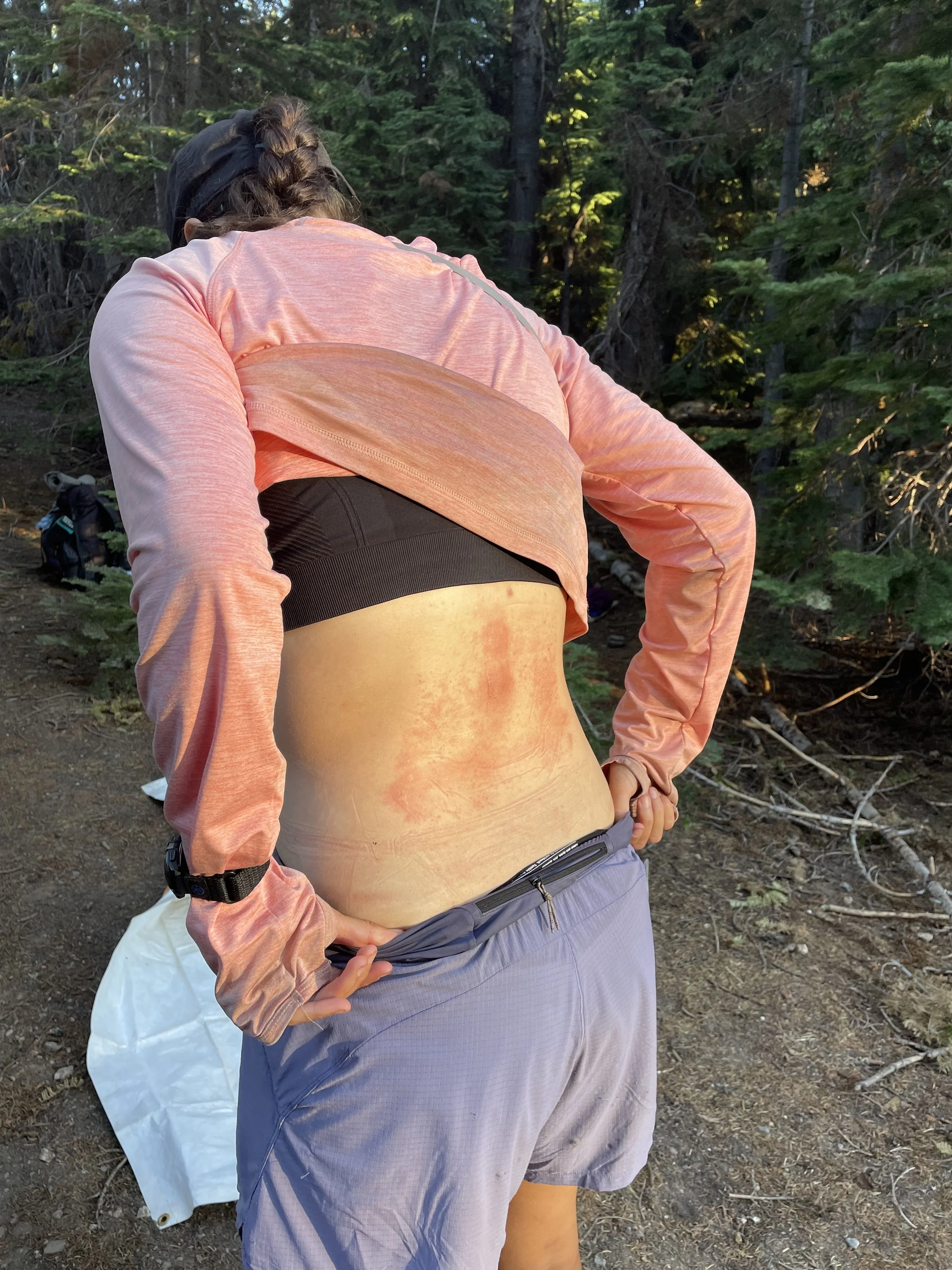 Painful heat rash :(