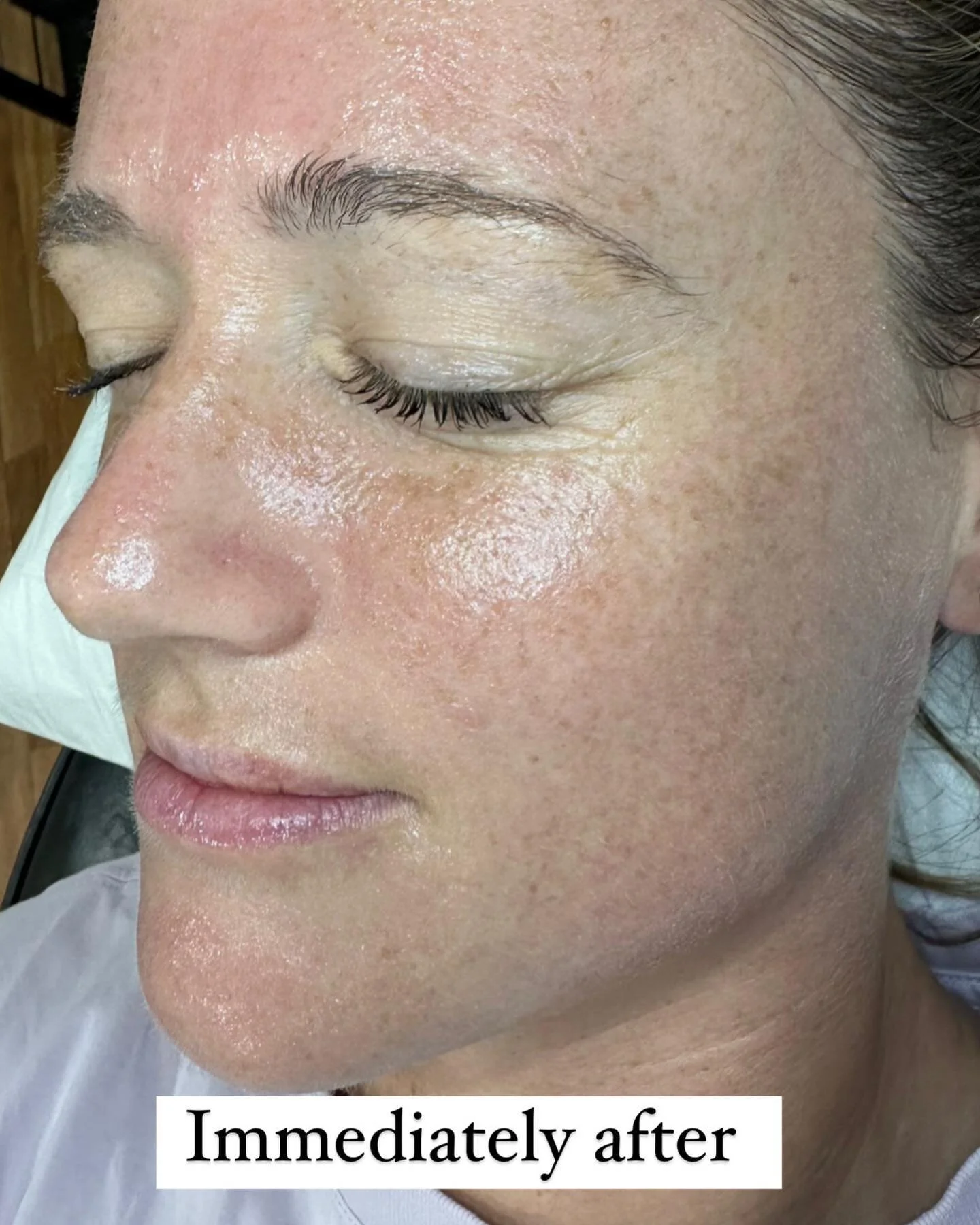 The chemical peeling process. 

There is a misconception that chemical peels cause a dramatic peeling reaction with lengthy downtime. Unless you are having a medium depth peel there is very minimal redness and peeling from superficial peels. Expect m