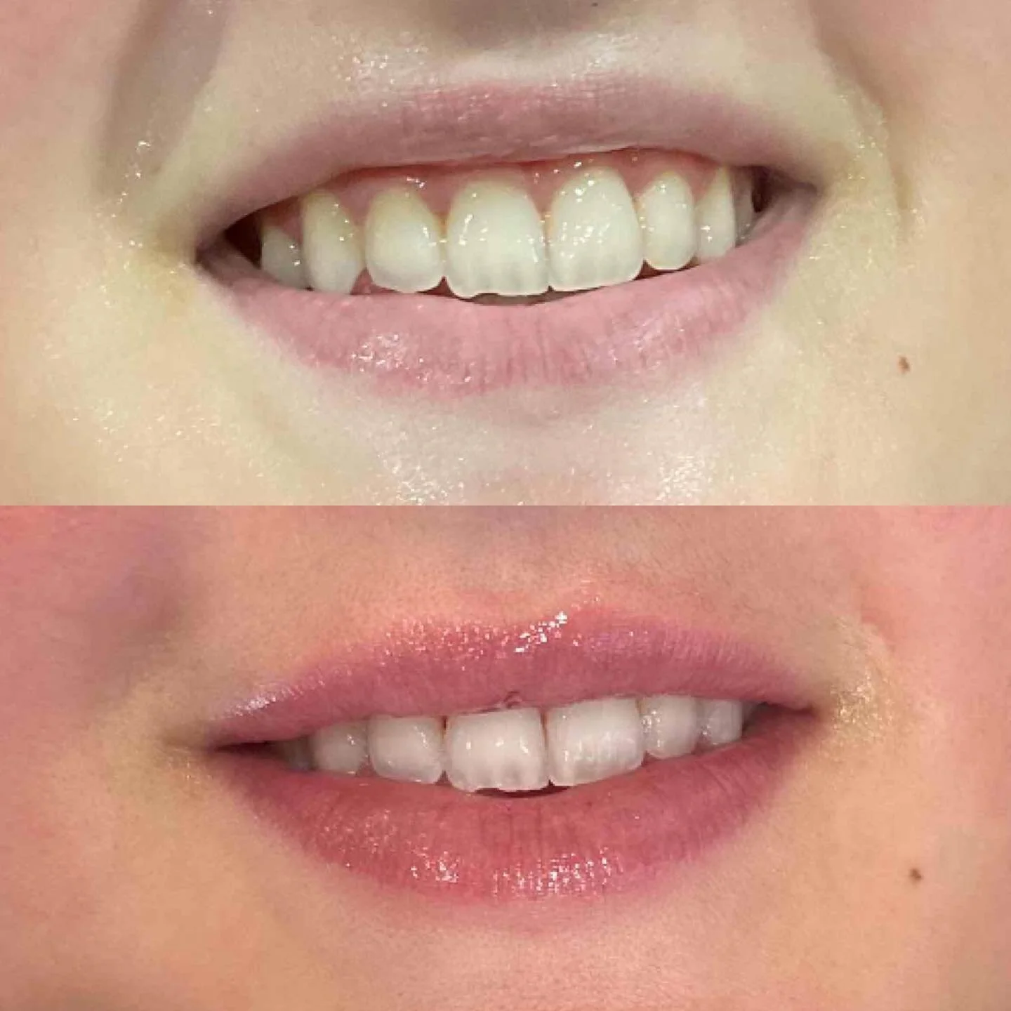 Subtle and soft improvement in definition, volume and smile 👄
