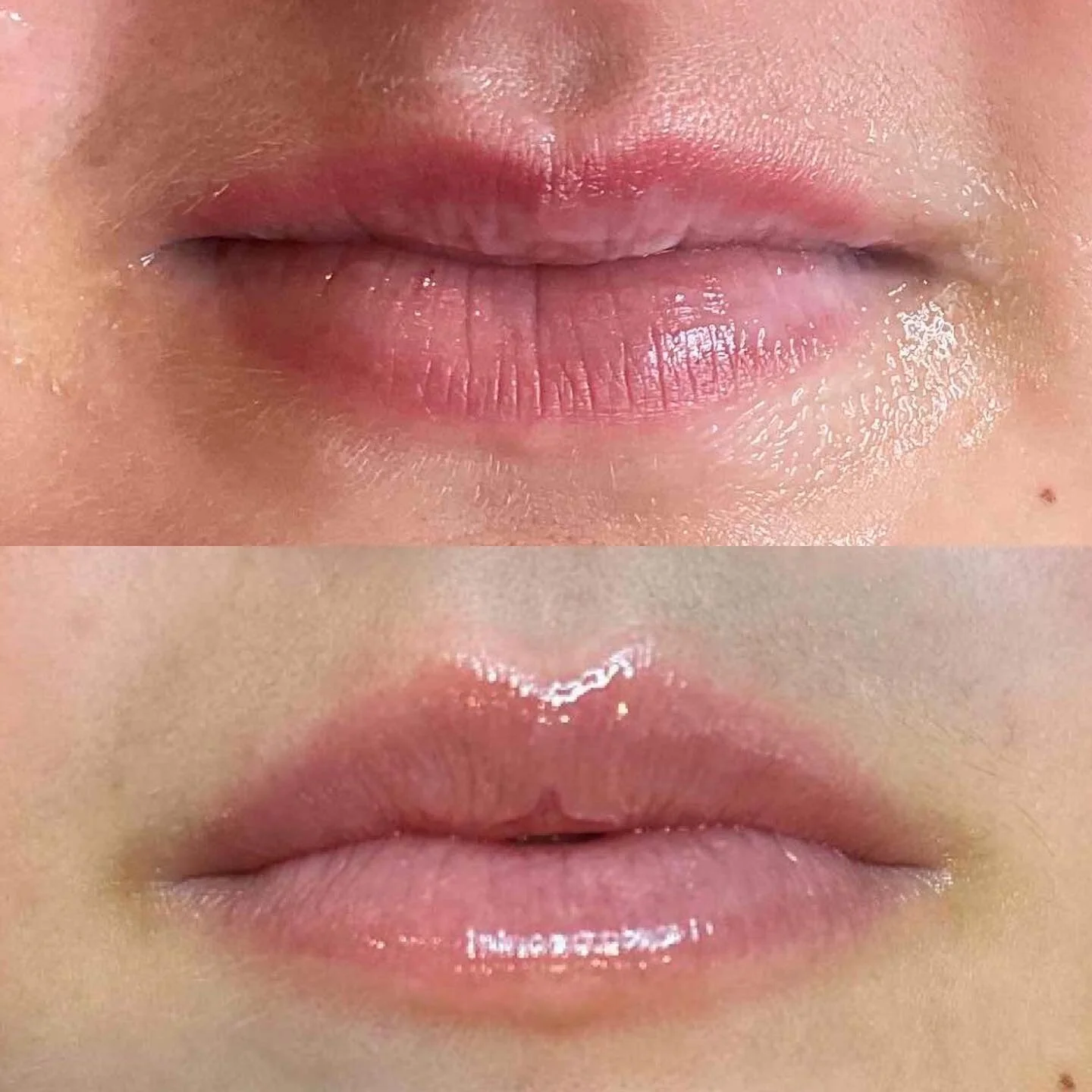 Before vs 3 weeks post 1.5mls premium dermal filler over two sessions. Results increased lip height, improved lip ratio and definition. Optimising this clients individual beauty. 

Book a consultation to see if this is the right treatment for you.