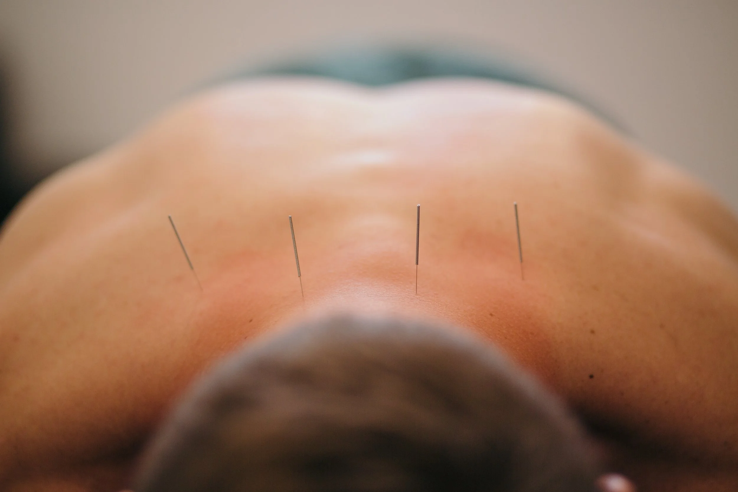 Traditional Chinese Medicine Acupuncture Ottawa