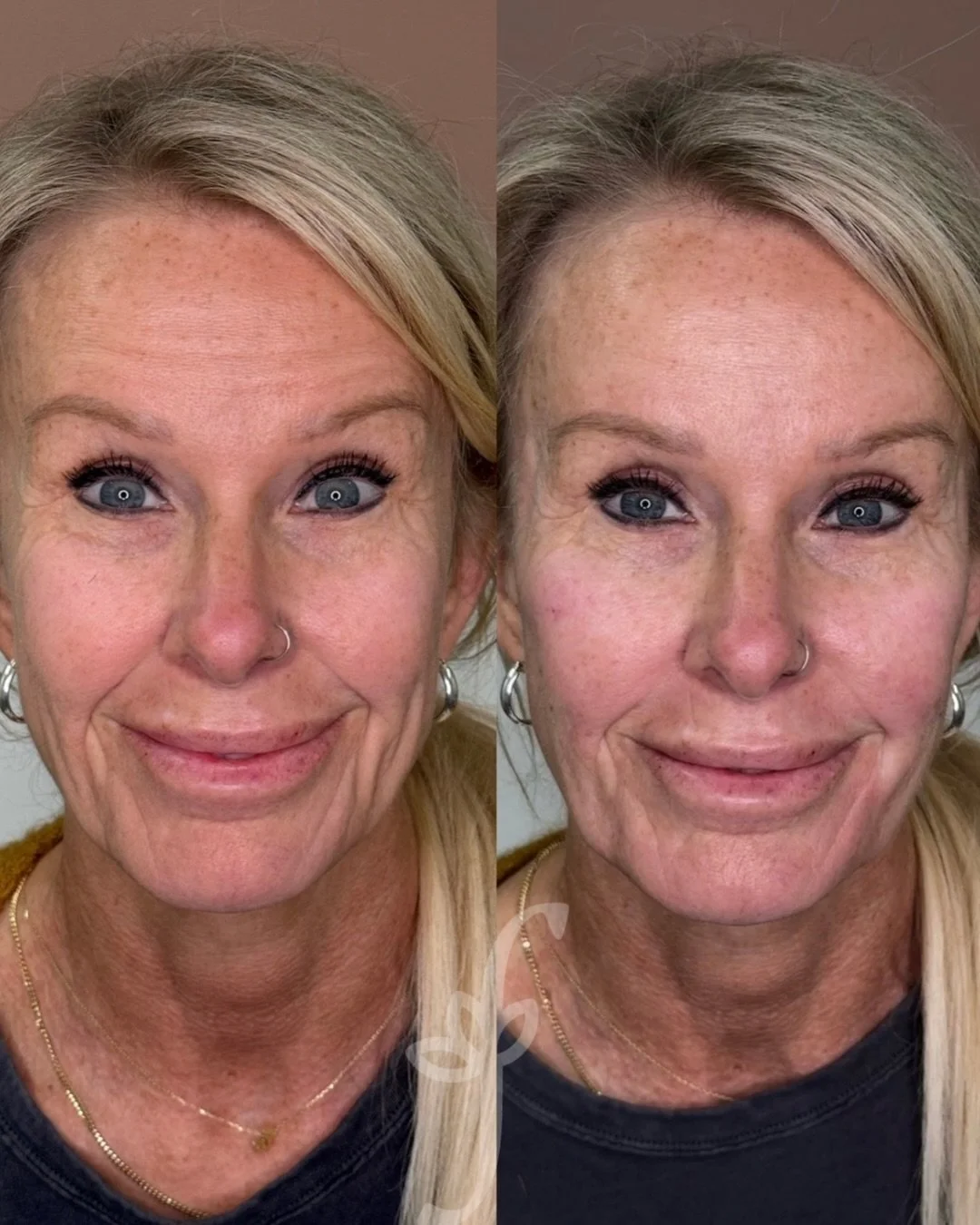 Happy Saturday!! 
Welcome to Coffee &amp; Contour&hellip; where we enjoy our Saturday coffee while admiring some really stunning before &amp; afters! ☕️💉✨

The magic of Radiesse is absolutely untouched! We showed you the how earlier this week (cannu