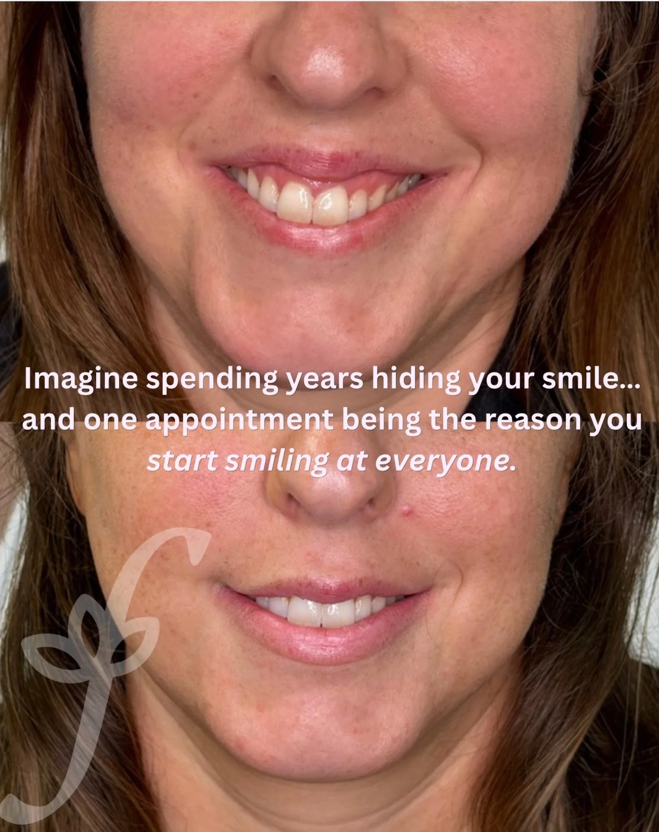Sometimes lip filler is about a lot more than lips.

It&rsquo;s about the woman who has spent years smiling with her mouth closed.

The one that always offers to take the photo instead of being in it.

The one who notices the thing she doesn&rsquo;t 