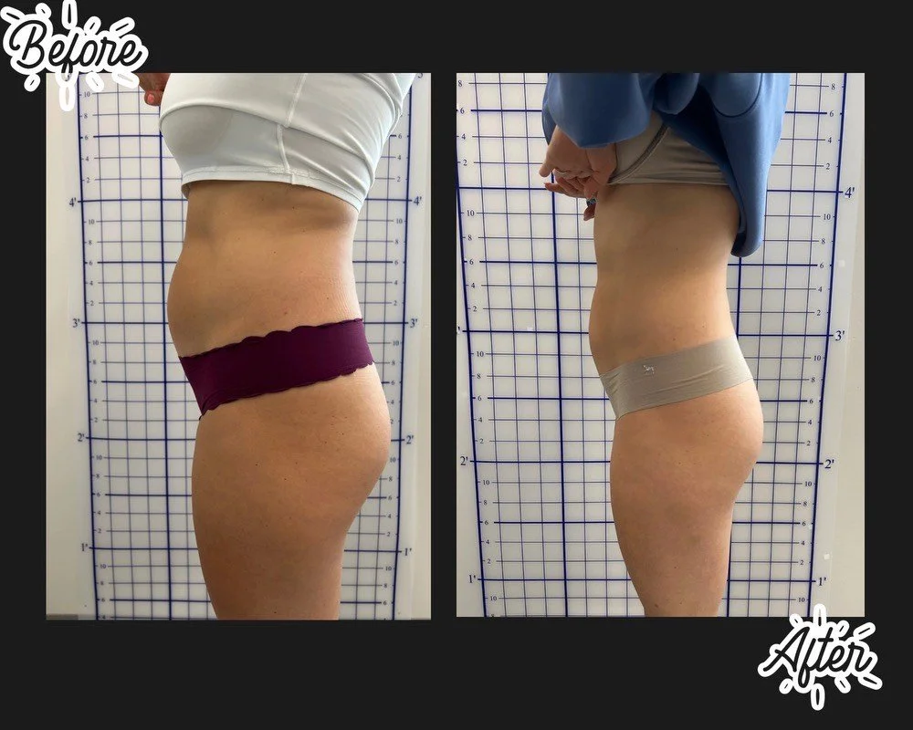 quick weight loss, easy weight loss, body contouring. Targeting fat