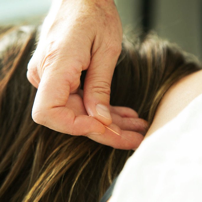 Close-up of a person receiving acupuncture treatment, with a thin needle being inserted into their neck or back.