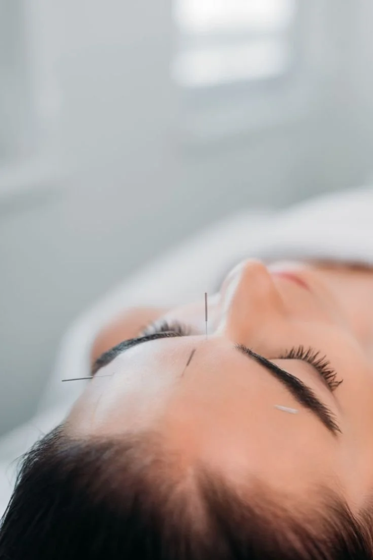 A person lying down with acupuncture needles on their face, eyelids closed, in a clinical setting.