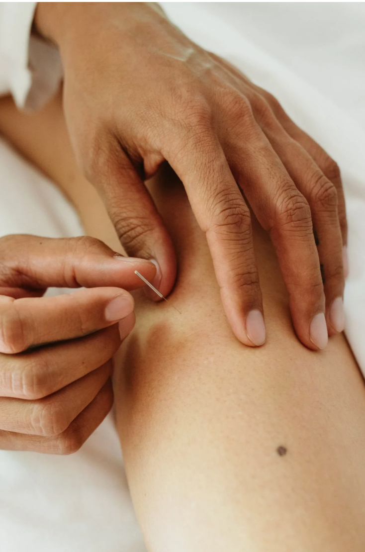 Person receiving acupuncture on their arm with a thin sterile needle being inserted.