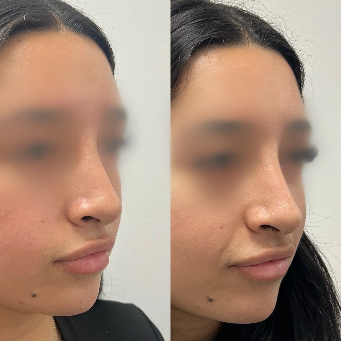 Yes, you can get a straighter, more refined nose with a more lifted and pointed tip without surgery! This can be done with dermal filler, PDO threads, tox, or a combination of the three. 

Book a consultation and get your dream nose ⬇️

Text +1 (551)