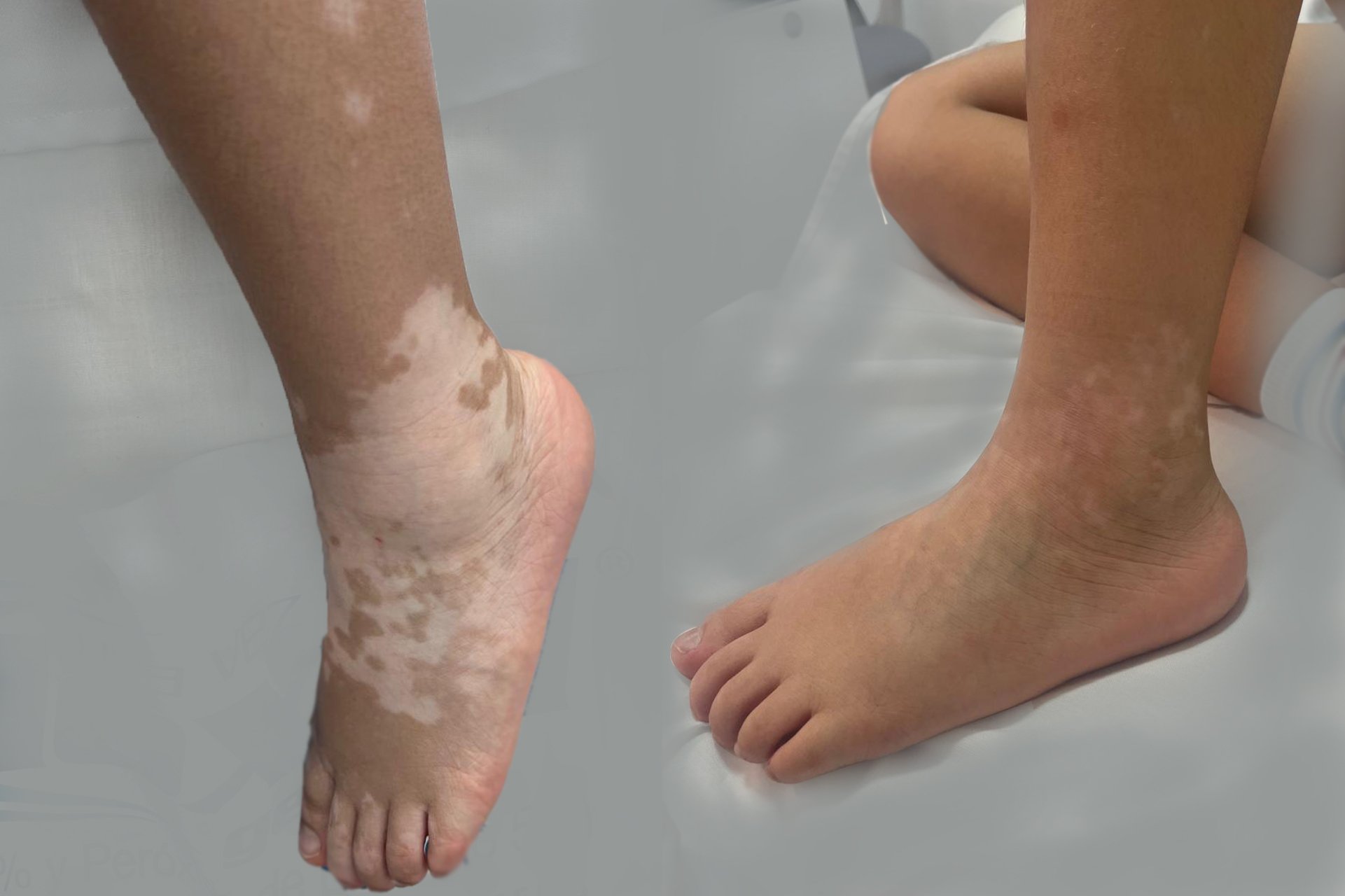 VITILIGO.jpg